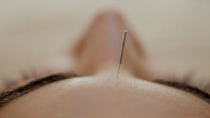 Akupunktur bei Migräne - Heilpraktikerin Eike Seibert in Landshut